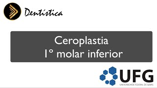 Ceroplastia 1º Molar inferior [upl. by Nilat]