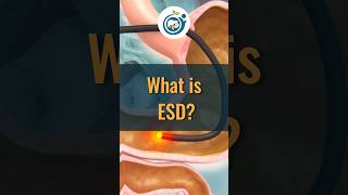 What is ESD Finally Revealed gastroenterologist digestivehealth [upl. by Anura]