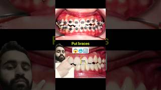 Braces fix misaligned jaw braces orthodontist dentist dentistry bracesoff [upl. by Elleinahc]