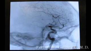 3D Cerebral Angiography [upl. by Deeann681]