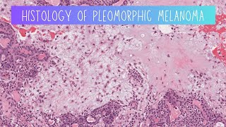 Histology of Pleomorphic adenoma [upl. by Octavia]