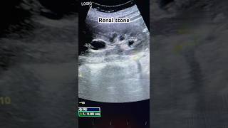 Kidney stoneRenal stoneUreteric stone stone kidney ultrasound reels shorts ultraradiology [upl. by Ainoda]