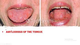 Amyloidosis Clinical course Symptoms and Signs Diagnosis and Prognosis of the disease [upl. by Shayla]