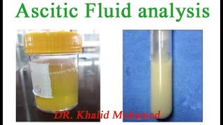 Ascitic fluid analysis تحليل السائل البريتوني [upl. by Hrutkay]