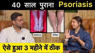 Psoriasis Treatment In Hindi Ft upasanakiduniya  Skin Disease  Himanshu Bhatt [upl. by Tarr752]