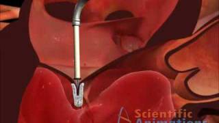 Cardiology  Mitral Valve Clip [upl. by Caresa]