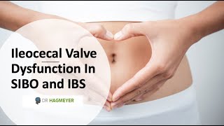 Healing The Ileocecal Valve amp Why Its Important In SIBOIBS [upl. by Uno]