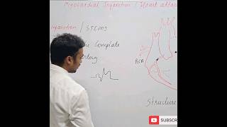 myocardial Infarction STEMI  Heart attack [upl. by Gunther]