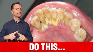 The 1 Top Remedy for Dental Plaque TARTAR [upl. by Anastos]