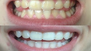 Enlighten  Teeth Whitening Process  London  Whites Dental [upl. by Lebar]