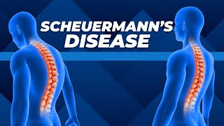 Top Three Exercises for Scheuermanns Disease [upl. by Ennovaj]