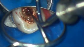 furcation perforation closure  закрытие фуркационной перфорации [upl. by Harned]