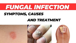 Fungal Infection Symptoms Causes and Treatment  How to Cure Fungal Infection [upl. by Trab]