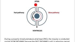 AV Nodal Reentry Tachycardia AVNRT for noncardiologist in less than 2 minutes [upl. by Tamah907]