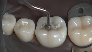 Class I Amalgam Preparation amp Restoration  Operative Dentistry [upl. by Carlynne]