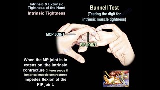 Intrinsic amp Extrinsic Tightness of the Hand  Everything You Need To Know  Dr Nabil Ebraheim [upl. by Treb]