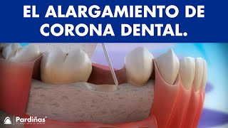 Alargamiento de corona dental © [upl. by Sofko]