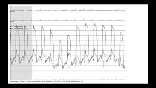 Hemodynamics 4 Constrictive pericarditis case studies Elias Hanna Univ Iowa [upl. by Nevram880]