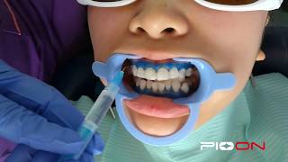 Teeth Whitening Bleaching [upl. by Leahplar]