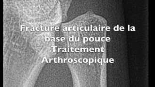 Chirurgie du pouce sous arthroscopie pour une fracture de Bennett Toulouse [upl. by Nilhtac]