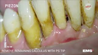 Dentální hygiena  EMS ultrazvuk [upl. by Inohs]