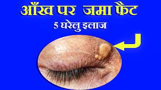 आंखों के पास पीले चकते का घरेलू इलाज  how to self treat XANTHELASMA [upl. by Phillis162]