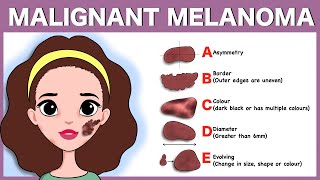 Malignant melanoma Signs Pathophysiology Types Diagnosis Treatment [upl. by Ode]