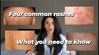 Four common rashes and everything you need to know about them [upl. by Cynthia360]