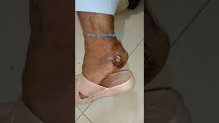 Lateral side of ankle fungal infection [upl. by Nikolas]