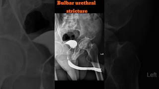 RGU  Retrograde urethrogram  Bulbar urethral stricture shorts rgu radiology specialcase [upl. by Krysta54]