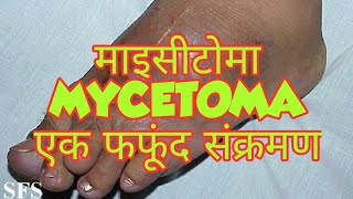 Mycetoma in hindi [upl. by Atenek]