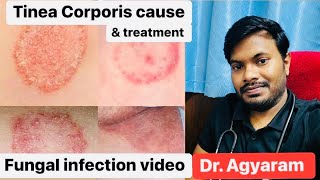 Fungal Infection  Tinea corporis Video  Fungel infection Cuase amp Treatment infection tinea [upl. by Amiaj]