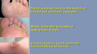 What are Foot Warts and How To Treat Them [upl. by Niel]