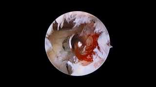 Elbow Arthroscopy  Osteoarthritis  Nicky Leung MD [upl. by Grubb731]