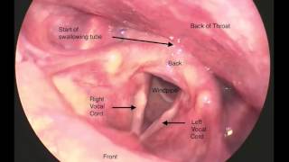 Laryngoscopy of the Vocal Folds [upl. by Brianne221]