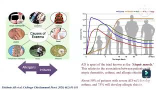 Atopic dermatitis diagnosis amp assessment Prof Ghada Shousha Pediatric immunology amp allergy Ain Shams [upl. by Fitts]