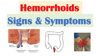 Hemorrhoids Signs amp Symptoms  Internal vs External Hemorrhoid Symptoms  Hemorrhoidal Disease [upl. by Wystand696]