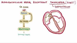 Atrioventricular reentrant tachycardia AVRT amp nodal reentrant tachycardia AVNRT [upl. by Beare]