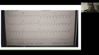 04 07 2024 Case Presentation Cirrhotic Patient for Right Hepatectomy [upl. by Houghton]