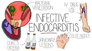 Infective Endocarditis With Duke Criteria amp Pathophysiology [upl. by Mckay]