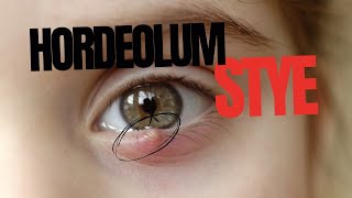 Stye Hordeolum [upl. by Casabonne]