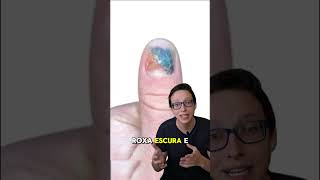 Hematoma Subungueal 💅😱 medicina medico curiosidades saude enfermeira enfermagem saúde [upl. by Einnek]