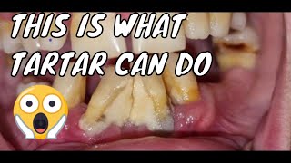 This is what tartar can do to your teeth [upl. by Audwin610]