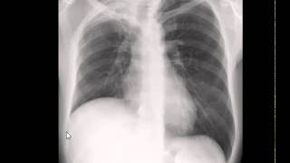 Chest xray interpretation Lung volume [upl. by Ynatirb]