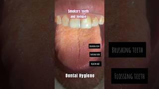 Smokers Teeth and tongue 👅 oralhealth vibes viraldentalbrushingdental flossing trending shor [upl. by Reta]