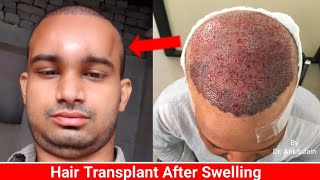 Swelling After Hair Transplant  When it go All about Swelling Best Hair Transplant in INDIA [upl. by Ylevol]