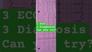 ecg ecginterpretation arrhythmia tachycardia palpitation cardiology [upl. by Trebor]