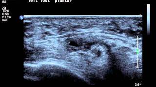 intermetatarsal bursa ultrasoundavi [upl. by Eleinad]