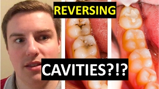 CAN YOU CURE CAVITIES AT HOME [upl. by Bealle]