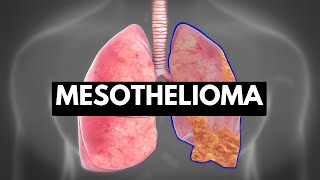 MESOTHELIOMA Causes Signs and Symptoms Diagnosis and Treatment [upl. by Dnomad552]